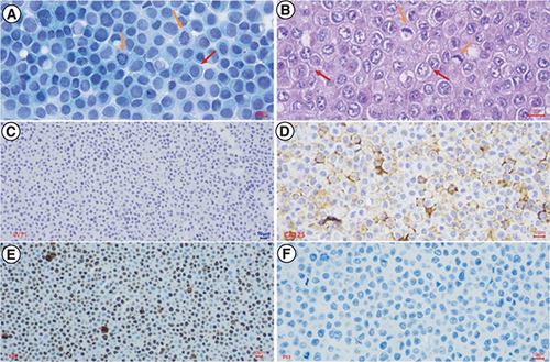 Figure 4. Histopathological and Immunochemical characteristics of M4 ovarian cancer cells in culture.After isolation, the M4 ovarian cancer cells were stained with PAP, H&E, and IHC to express the WT1, CA125, Ki67, and p53 proteins. (A) PAP-stained isolated tumor cells showed high cell density, large polygonal epithelial cells with abundant basophilic cytoplasm (red arrow), and a high nuclear/cytoplasmic ratio. Nuclei were round or oval, rough chromatin, mitotic nuclei visible (yellow arrows); (B) H&E-stained isolated tumor cells revealed high cell density, epithelial cells with adhesions, polygonal in shape (red arrow), some cytoplasmic had a light cavity. Tumor cells had a high nuclear/cytoplasmic ratio (yellow arrow). Cell nucleus was round or oval, with rough chromatin, revealing many abnormal nuclei (green arrow); (C) Immunochemistry staining. Malignant cells didn't reveal nuclear staining with WT1; (D) Immunochemistry staining. Malignant cells showed strong and diffuse membranous staining with CA125; (E) Immunochemistry staining. Malignant cells expressed strong and diffuse nuclear staining with Ki67, accounting for 80%; (F) Immunochemistry staining. Tumor cells revealed a complete absence of staining with p53.