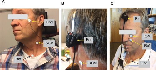 Figure 2 In cervical vestibular evoked myogenic potential (cVEMP), bipolar electrodes were placed: one at sternocleidomastoideus muscle (SCM) and the reference was placed at the upper rim of the sternum, and the ground at the upper cheek (A and B). In ocular vestibular evoked myogenic potential (oVEMP), bipolar electrodes were placed: one just beneath the eye over the inferior oblique muscle (IOM) and the reference ~2 cm below, whereas the ground was placed at the upper rim of sternum (C). Bone-conducting transducers were applied using a steel spring arrangement either to the mastoid (Fm) just behind the pinnae at the virtual line through the ear canal opening and lateral eye hook or at the forehead (Fz) on the midline just below the hairline (B and C). Written informed consent has been obtained from the person in these images to publish.