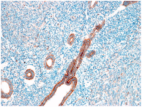 Figure 4. Immunohistochemistry analysis of VEGF Expression in foci of adenomyosis, associated mainly with the epithelial cells. IHC MAT to VEGF, original magnification 80×.