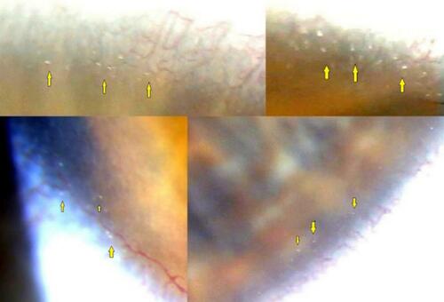 Figure 3 Slit-lamp biomicroscopic findings in several patients with BCD with corneal involvement. Crystalline-like corneal deposits (arrows) can be present in 360º degrees of the limbus area of both eyes.