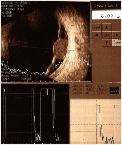 Figure 1 Ultrasound scan of the left eye.