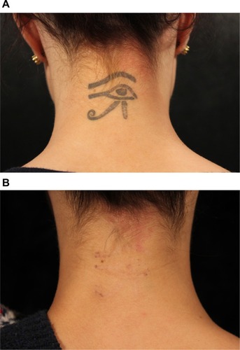 Figure 3 Professional tattoo before (A) and after third picosecond Nd:YAG laser treatment (B).