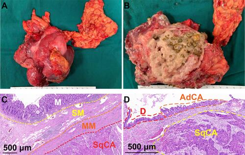 Figure 3 Pathology studies confirmed the diagnosis of gallbladder cancer. (A) The resected sample with adjacent colon and liver tissues. (B) Cross-sectional profile showing huge gallbladder mass and multiple gallstones. (C) H & E staining showing tumor’s involvement of colon. (D) H & E staining of gallbladder adenosquamous carcinoma.