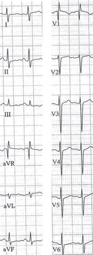 Figure 1. EKG on admission showing electrocardiographic signs of right-ventricular overload, i.e. vertical-to-right axis, right bundle branch block.