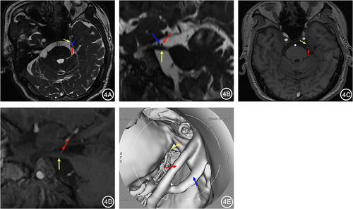Figure 4 A 67-year-old female with left TN for 1 year. 3D-FIESTA-c axial (A) and sagittal (B) showed compression on the left trigeminal nerve (yellow arrow) by the Petrosal Vein (blue arrow) and Superior Cerebellar Artery (red arrow) from above. 3D-TOF-MRA axial (C) and sagittal (D) showed only the compression of the left trigeminal nerve by the Superior Cerebellar Artery (red arrow), with no other visible vascular. MRVE image (E) showed compression on the left trigeminal nerve by the Petrosal Vein (blue arrow) and Superior Cerebellar Artery (red arrow).