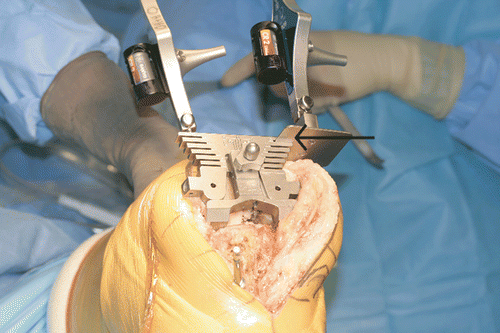 Figure 1. Posterior reference guide set at 3° of external rotation. A navigated tracker has been coupled to the posterior referencing guide (arrow); the degree of rotation created by the guide was measured and compared to the previously registered values for the TEA and Whiteside's line. [Color version available online.]