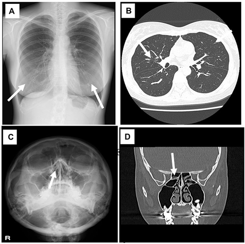 Figure 4 Chest and facial x-ray and computed tomography (CT) findings of patient 2. Chest x-ray (A) and CT (B) show only small nodules and slight bronchiectasis in both middle-lower lung fields, respectively (arrows). Facial x-ray (C) and CT (D) suggested the right sinusitis. Arrows indicate the suggested lesions of the right paranasal sinus.