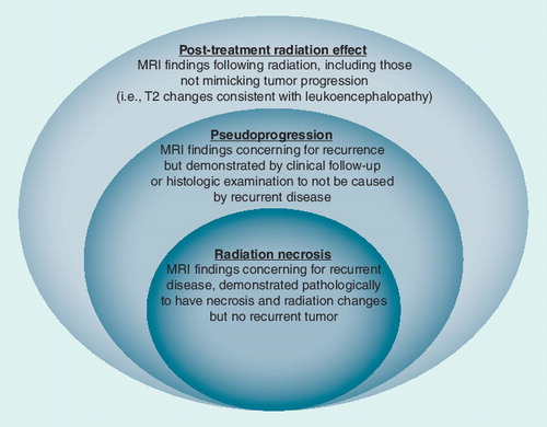 Figure 2. Spectrum of imaging findings, in the absence of recurrent disease, following adjuvant radiation treatment for high-grade glioma.