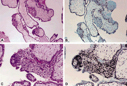 Figure 1. Very early hydropic abortion at 10 × lens (A and B) and 20 × lens (C and D) hematoxylin and eosin stain (A and C) and positive staining for p57 (B and D) in the cytotrophoblast, mesenchymal cells, and intermediate trophoblast.