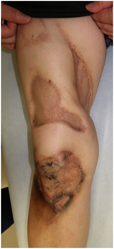 Figure 5. Six months after the last surgical treatment, the patient had no apparent wound infections or new ulcerations.