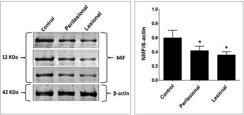 Figure 3 Lesional and perilesional expression of macrophage migration inhibitory factors in patients with verruca vulgaris and control group using Western blotting technique. The panels on the right represent the corresponding quantification of each analysis as measured by ImageJ software and expressed as the relative band density to that of β-actin. The level of significance was accepted as p<0.05, and all relevant results are graphically displayed as the mean±SD (n = 3), showing lower MIF expression in both lesional and perilesional verruca vulgaris skin biopsies compared to the controls with lack of significant difference in MIF expression between lesional and perilesional verruca vulgaris skin biopsies. *indicate significant change from the controls at p < 0.05.