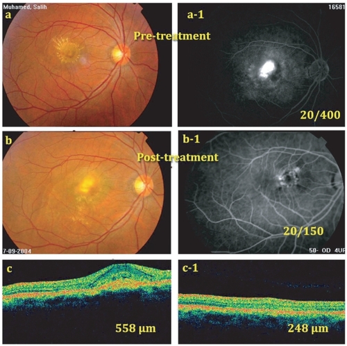 Figure 1 (a) and (a-1) Pretreatment fundus photo and pretreatment FLA, late phase, showing filling of predominantly classic CNV occupying more than 50% of the lesion. Pretreatment BCVA = 20/400. (b) and (b-1) Post-treatment fundus photo and FLA, late phase, at 6 months showing closure of the CNV with only late leakage at its upper temporal edge (BCVA = 20/150). (c) Pretreatment OCT showing CNV with CRT = 558 μm. (c-1) OCT, 6 months post-treatment showing absorption of most of subretinal fluid and reduction of CRT to 248 μm. However, fovea did not return completely to normal configuration.