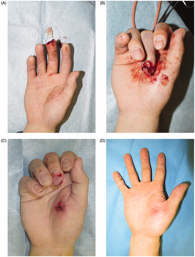 Figure 4. (A) Complete right middle finger tip amputation. (B) Fixed skin flap from the thenar site. (C) Detached the thenar flap after 2 weeks after first operation. (D) At 3 months after surgery, there is favorable fingertip form, no contracture in the skin grafted area, and good color/texture match.