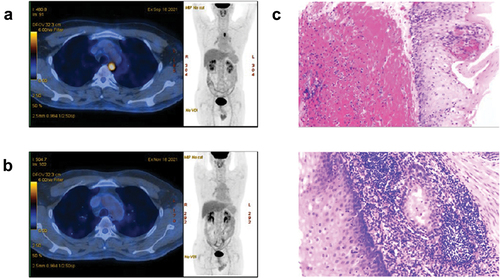 Figure 1. Clinical and pathological profile of the patient who achieved pCR following neoadjuvant immunotherapy combined with chemotherapy. (a) Pre-treatment PET-CT image; (b) Post-treatment PET-CT imaging evaluation; (c) Post-treatment pathological image (congestion visible in submucosal lesions, accompanied by lymphocyte infiltration, no cancer observed).