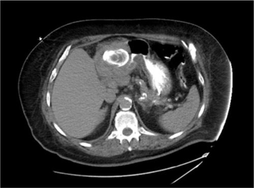 Figure 2 Initial computed tomography of the abdomen revealed significant inflammatory changes around the gallbladder with a large 5 cm gallstone exerting significant mass effect on the antrum of the stomach.