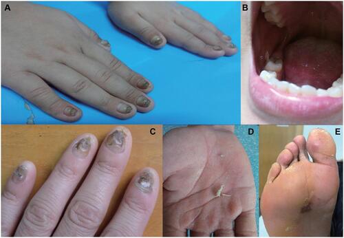 Figure 1 Clinical manifestations of patients. (A) Thickened and dark fingernails. (B) Oral leukokeratosis. (C) Thickened and discolored fingernails. (D, E) Palmar hyperhidrosis and palmoplantar keratoderma.