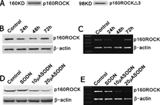 Figure 1 A, Expression of endogenous p160ROCK and p160ROCKΔ3 mutant in Caov-3 cells. Western blot analysis of p160ROCK in Caov-3 cells. p160ROCK protein was stained with anti-p160ROCK antibody in the left column. The right column shows lysates from p160ROCKΔ3 mutant cells immunoblotted with an anti-myc antibody. p160ROCK Δ3 was tagged with a MYC epitope at its N-terminus. B, C, D and E show the inhibition of ASODN to p160ROCK expression. p160ROCK immunoblotting and RT-PCR demonstrated the decrease of p160ROCK expression after treatment with the ASODN at different does (10 and 20 μ M) or 20 μ M within various period time (for 24 h, 48 h and 72 h).