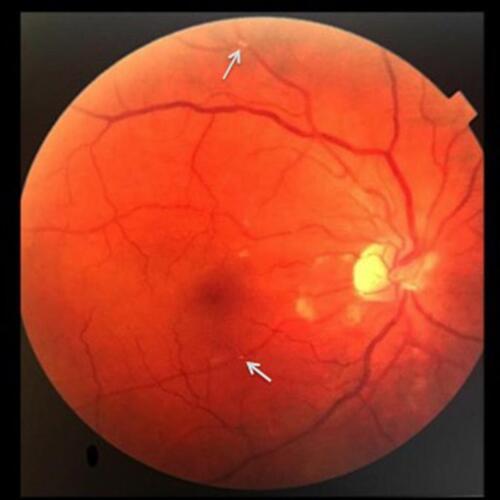 Figure 2 Fundus autofluorescence: abnormalities in branches of central retinal artery.
