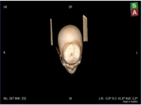 Figure 5 Superior view of the CT scan of the head with 3D reconstruction showing the bifrontal mass.