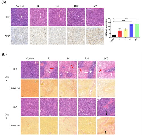 Figure 3. Histologic and immunohistochemical assessment. (A) The LMLs were subjected to a tissue chip analysis. Slides were stained with H-E (upper) and Ki-67 (lower). Quantification of the number of Ki-67-positive cells in the LML after surgery in all of the different groups (DAM were subjected to the histology analysis. The white, red and black arrows indicate the viable hepatocyte islands, necrotic area and fibrous tissues, respectively) (*** or ###, P < 0.001). (B) The RMLs (congestive liver tissues) of the different groups exhibited different changes; thus, the representative images of H&E-staining were presented, respectively. Collagen deposition was detected by Sirius red staining. In the RM and LVD group at POD7, the DAR were necrotic.