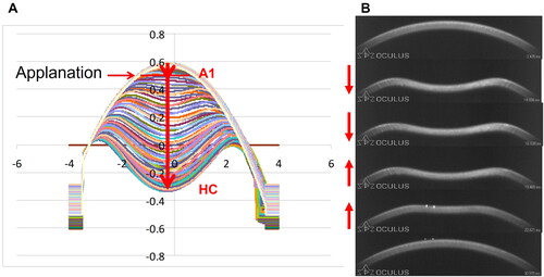 Figure 4. (A) A series of anterior surfaces of the deforming cornea plotted throughout the air puff showing initial displacement (short thick red arrow) from the undeformed surface to first applanation (A1), marked by a horizontal red line, and further displacement (longer thick red arrow) from first applanation to the highest concavity (HC) limit of corneal deformation. (B) A series of frame captures from a video of the cornea deforming under an air puff with red arrows indicating direction of motion.