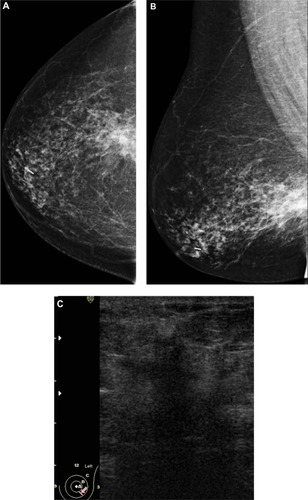 Figure 3 A 58-year-old female with palpable mass in the left breast. (A and B) CC and ML mammogram films revealed ill-defined dense opacity with spiculated margins surrounded by architectural distortion at the lower central area of the breast, which looks to be attached to the pectoralis muscle posteriorly. (C) On ultrasound, ill-defined, spiculated, hypoechoic, solid mass with posterior shadowing measuring 16 × 13 mm is seen at 5 o’clock of the breast.
