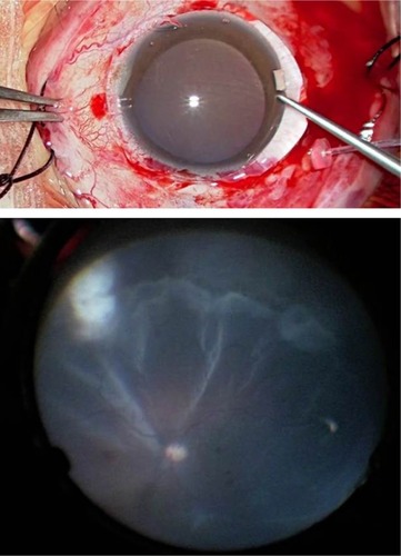 Figure 6 Application of the contact lens in a scleral buckling case (top). Fundus view through the contact lens with the wide-angle viewing system (bottom).