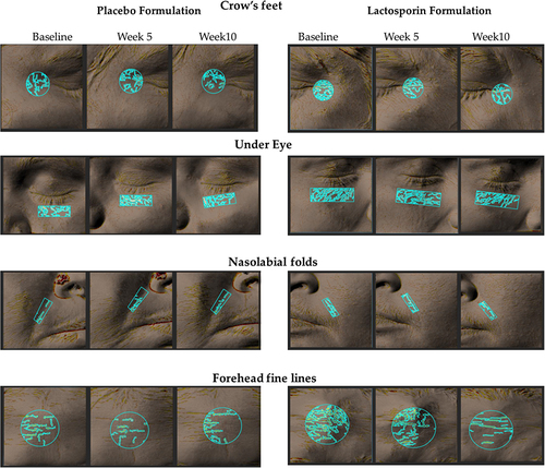 Figure 3 Analysis of topographical features of the skin by Antera 3D. Representative images from Antera 3D, showing the changes in crow’s feet, under-eye fine lines, nasolabial folds, and forehead fine lines in placebo and LactoSporin at baseline, week 5 and week 10. The blue marks represent wrinkles within the area of interest. A lower value indicates less severity and an improvement.