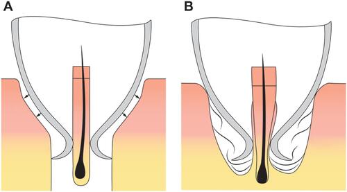 Figure 9 The frustoconical punch shape (A) increases the resistance with deeper punch penetration. (A) Resistance increases with the firmness and thickness of the tissue and (B) causes blunt separation of the lateral anchoring elements.