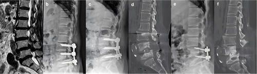 Figure 7 MRI showed L3-5 LCS before the initial operation (a). Immediate postoperative x-ray (b) and x-ray at 6 months after the first operation (c). CT before the revision surgery showed loosened PS and L45 union failure (d). Immediate postoperative x-ray and postoperative CT at the final follow-up (e and f).