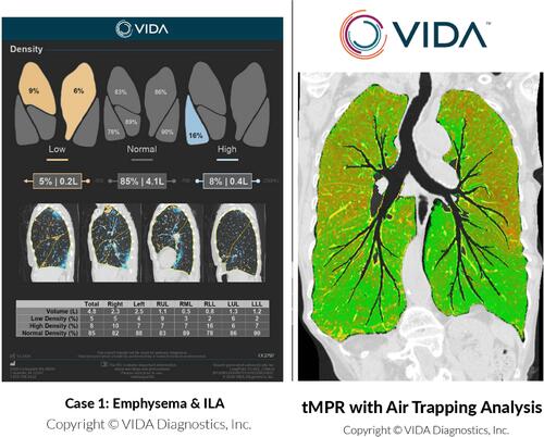 Figure 2 Representative clinical report (left) and tMPR (Topographic Multi-Planar Reformat; right) with air trapping map, courtesy of VIDA Diagnostics, Inc.