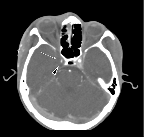 Figure 2 Axial post contrast CT angiography of the brain shows symmetrical non-enhancing right cavernous sinus (arrowhead), reduced caliber of the right internal carotid artery cavernous segment (arrow) swelling of the right temporal lobe and swelling and enhancement of the subcutaneous right temporal region as well as the orbital septum (short arrow).