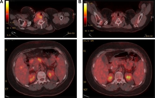 Figure 2 PET/CT scan before lenalidomide/celecoxib (A) and after six cycles of lenalidomide/celecoxib (B).