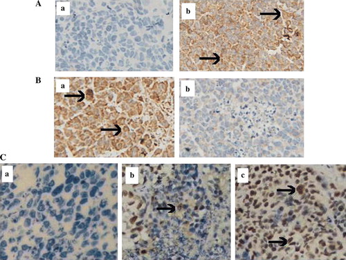 Figure 6.  Immunohistochemical and apoptotic study in vivo 7 day post-treatment with viruses. A immunohistochemistry was performed in the tumor sections by reaction with the primary antibody against TRAIL, group b treated with ZD55-TRAIL plus ZD55-XIAP-shRNA displayed much higher TRAIL expression than group a treated with PBS as control. B XIAP expression level in vivo, group b treated with ZD55-TRAIL plus ZD55-XIAP-shRNA indicated much lower staining than group a (PBS). C TUNEL assay was performed to detect apoptosis in the tumor section: group c (ZD55-TRAIL plus ZD55-XIAP-shRNA) showed extensive staining than control group a (PBS) and group b (ZD55-TRAIL plus ONYX-015). (Original magnification×400, arrows denote positive staining).