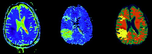 Figure 5.  A stroke patient. Images are ADC map, MTT map and the segmented image.