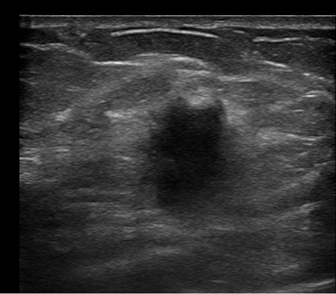Figure 5 MMBC, 49-year-old female patient. An irregular hypoechoic lesion can be seen in the lower inner quadrant of the left breast. The edges are not smooth, with visible “angular” features and a “malignant halo (note: indistinct border with halo)”. There is no “halo sign”, and the echo behind the mass is attenuated (has posterior shadowing).