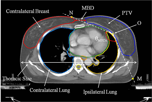 Figure 1 Anatomic parameters in maximum concave target shape; O is the reference point, while OM and ON are lines at an angle of θMTCA. MBD is the minimum distance between contralateral breast and planning target volume (PTV). θMTCA is defined as the minimum target concave angle of PTV.