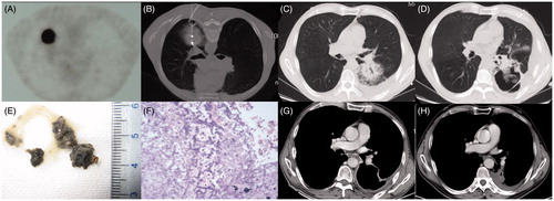 Figure 1. (A) PET-CT image from case 1 showing a single peripheral lesion, 40 × 38 mm, in the superior segment of the left lower lobe and with high FDG uptake before MWA. (B) CT scan showing a drainage tube placed in the pleural cavity and microwave antennas used for MWA. (C) At 10 days after tumour ablation, the ablated area, 55 × 50 mm, displaying GGO and mild pleural effusion. (D) At 18 days after tumour ablation, the ablation zone has been replaced by a large thin-walled cavity containing a mass of irregular consolidation with an air crescent sign. (E) Macroscopic appearance of expectoration. (F) Photomicrograph of expectoration revealing numerous Aspergillus hyphae (×40, haematoxylin and eosin staining). (G) A contrast-enhanced CT scan at 7 weeks after MWA showing a thin-walled cavity with a smooth lining and fistula formation between the cavity and left inferior lobar bronchus. (H) An enhanced CT follow-up scan at 6 months after MWA showing gradual involution of the cavity.