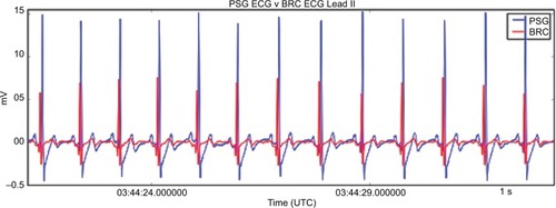 Figure 2 Electrocardiogram measurements.