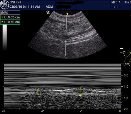 Figure 1 Right diaphragm thickness on B-mode ultrasonography.