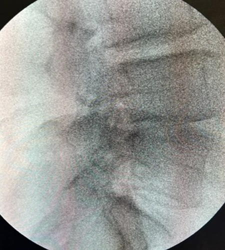 Figure 1 Pre-Op, Lateral, L4/L5, Angular Instability.