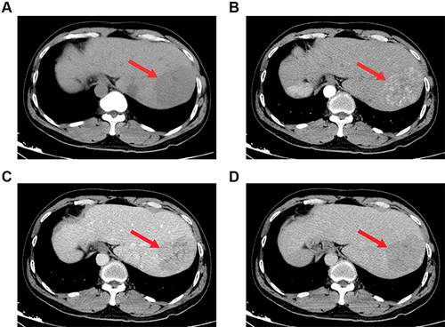 Figure 2 Computed tomography (CT) scans before stage I surgery. A giant mass (red arrow) measuring 7.1 × 5.5 × 5.6 cm in liver segments 8 was showed on CT scans. (A) plain scan; (B) arterial phase; (C) portal venous phase; (D) venous phase.