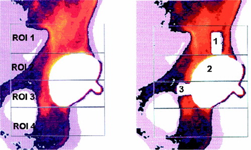 Figure 3. DEXA scan marked with the modified Wilkinson regions of interest (ROIs) with 10×20 mm defects (left) and with metal spacers in the defects (right).