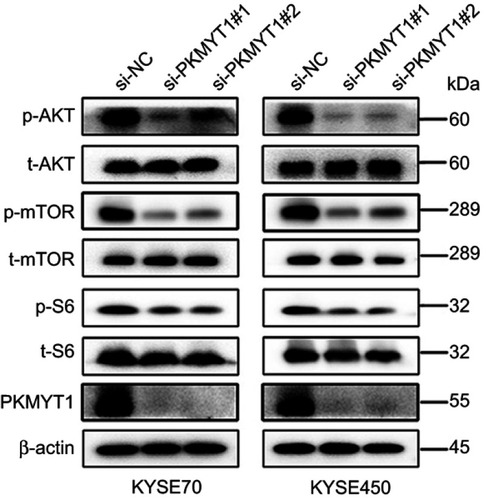 Figure 5 Knockdown of PKMYT1 expression suppressed the AKT/mTOR pathway. The expression of p-AKT, p-mTOR, and p-S6 was decreased in siRNA groups than NC group.Abbreviations: PKMYT1, protein kinase, membrane associated tyrosine/threonine; NC, negative control.