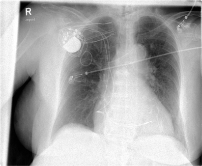 Figure 4 Chest X-ray prior to discharge demonstrates correct position of the leads.