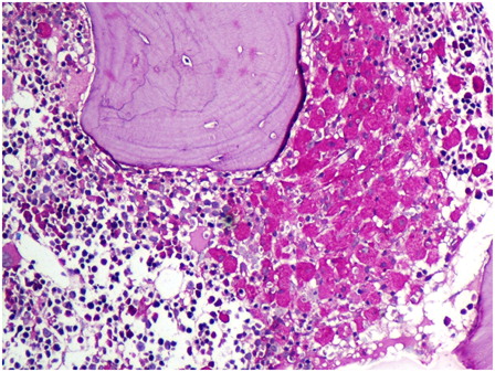 Figure 4. The pseudo-Gaucher cells are brilliantly positive with cytochemical stain for periodic acid Schiff (hematoxylin counterstain, ×400).