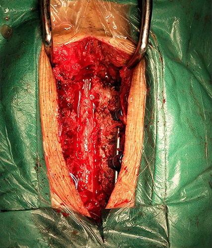 Figure 2 The hematoma was situated on the right side of the spinal cord.