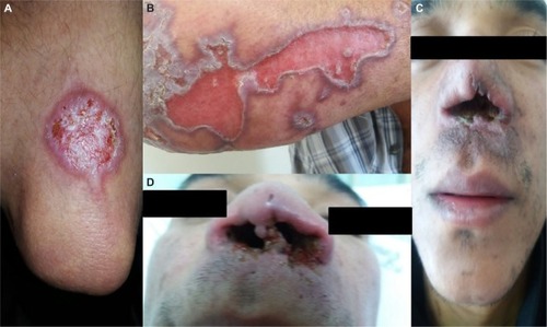Figure 2 Lesions of tegumentary leishmaniasis.