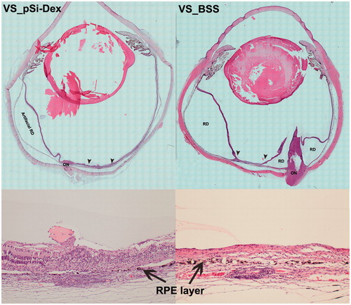 Figure 6. Histological analysis. The two images in the left column are from an eye treated with intravitreal pSiO2-COO-DEX (pSi-Dex) while the two images on the right column are from an eye treated by intravitreal BSS as control. In both eyes, the subretinal Matrigel + VEGF was injected in the visual streak (VS). The two images at the bottom are 10× light microscopy images corresponding to the area between the two arrowheads in the montages above. The montage VS_pSiO2-COO-DEX (VS_pSi-Dex) displays the injection site (between two arrowheads) next to the optic nerve (ON) and artificial retinal detachment (RD) from histological processing, evidenced by detachment between the RPE and choroid instead of neuroretinal detachment. In contrast, the montage VS_BSS demonstrates prominent proliferation of the optic nerve (ON) protruding into the vitreous, causing multiple pathological retinal detachments (RD). The RD inferior to the injection site is pathological RD with stiff retina and retinal gliosis. The magnified injection area shows RPE (arrows) damage and irregular proliferation with overlying retina atrophy and disorganization (Bottom images).
