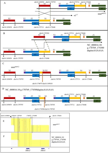 Figure 3. The possible rearrangement mechanism for the novel haplotype (NC_000016.10:g.170769_174300dupinsAAAAAA). The located positions are aligned to genome build hg38. (A) The rearrangement mechanism for the αααanti4.2. (B) The possible rearrangement mechanism for the novel haplotype. (C) The gene arrangement for αααanti4.2. The bold orange arrow shows the most common breakpoints. (D) The gene arrangement for the novel haplotype. The bold orange arrow shows the breakpoints. (E–F) The comparison between αααanti4.2 and NC_000016.10:g.170769_174300dupinsAAAAAA displayed by Integrative Genomics Viewer (IGV).